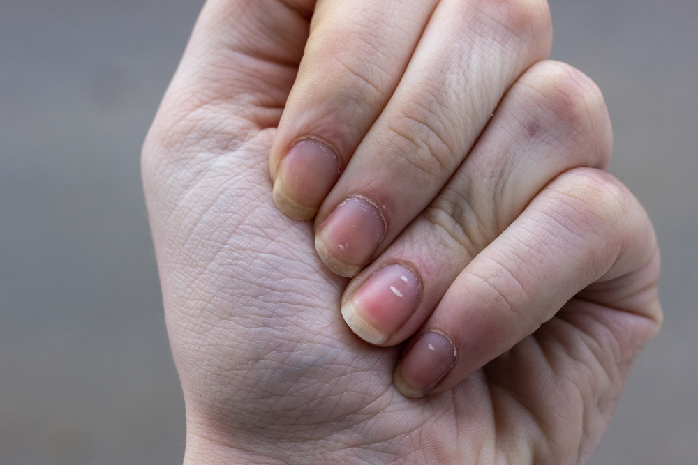 How To Get Rid Of White Marks On Finger Nails