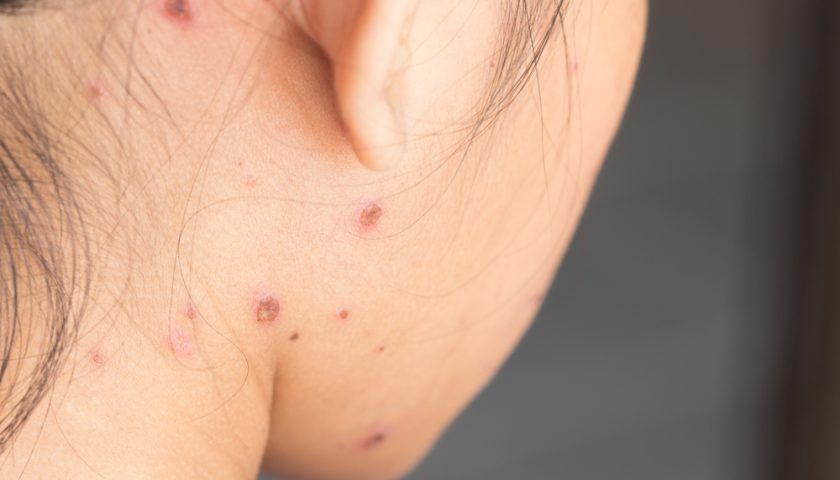How to Remove Chicken Pox Scars