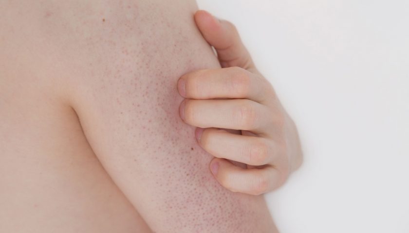 Sily Smooth Solutions To Treat Chicken Skin