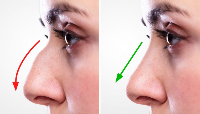 Surgical vs Non Surgical Rhinoplasty