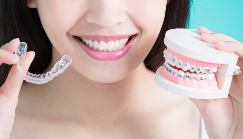 Braces Vs Invisalign