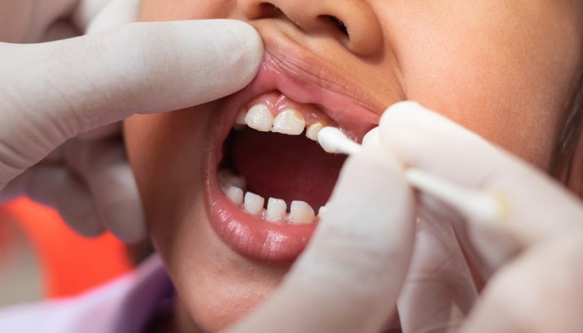 Fluoride Benefits