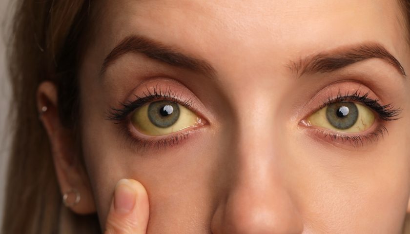 How to Get Rid of Yellow Eyes