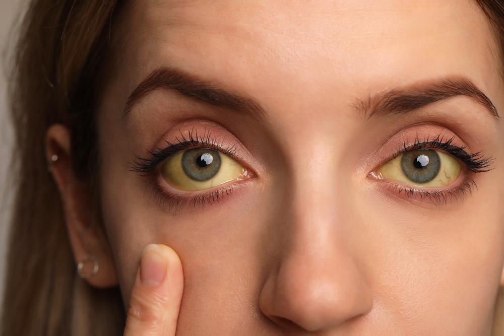 How To Get Rid Of Yellow Eyes Home Remedies That Work Healthwire