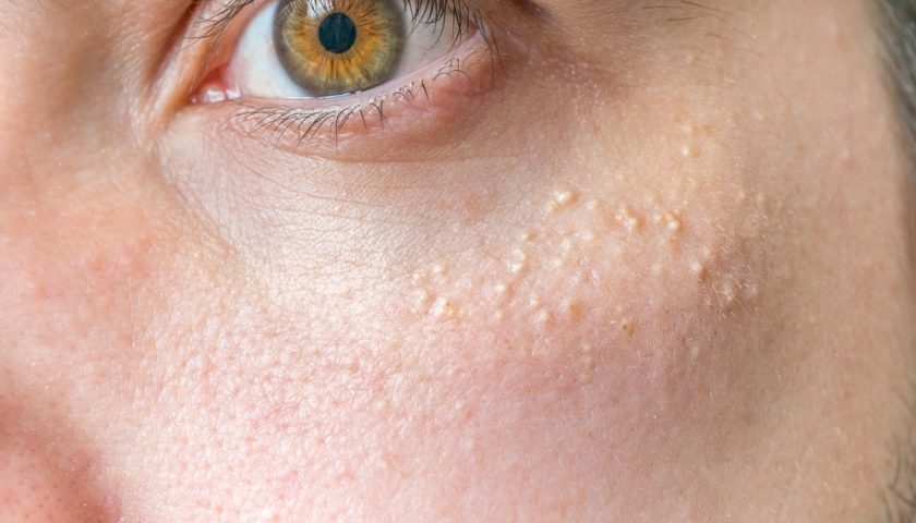 Get Rid of Milia Under Eyes