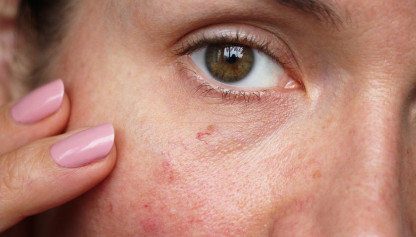 Thin Skin Treatment