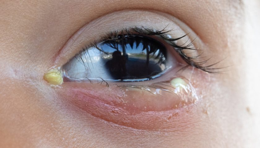 Crusty Eyes in the Morning