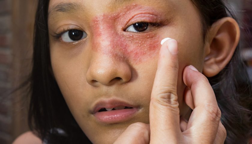 Manage Eczema Around the Eyes