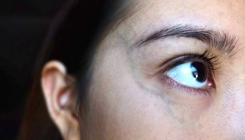 How to Conceal the Veins Under Eyes