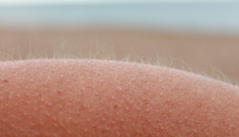 How to Deal with Raised Skin Bumps