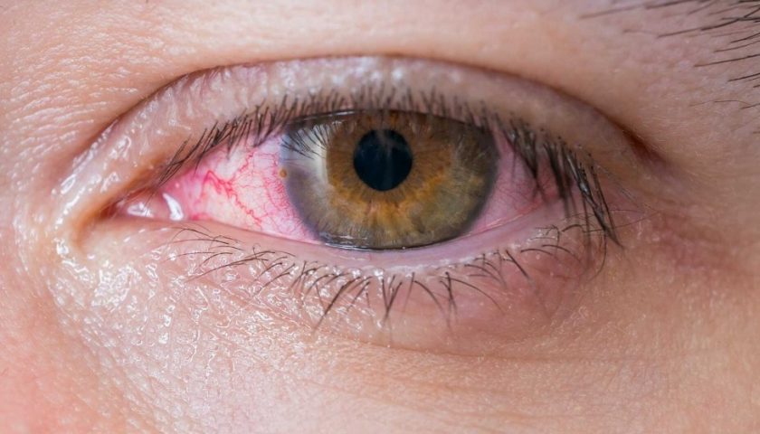How to Get Rid of Tired Eyes