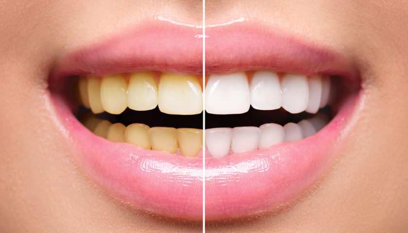 Is Teeth Whitening Safe