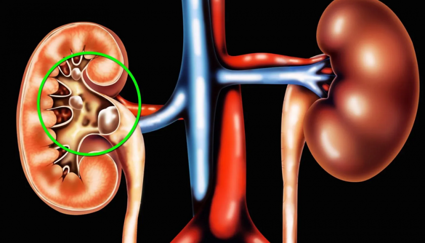 Kidney Stones Vs. Kidney Cancer