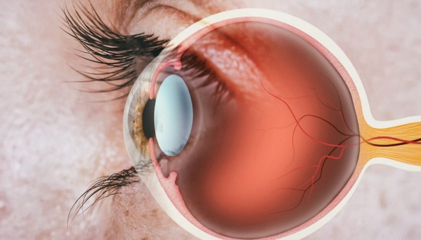 Myopic Macular Degeneration