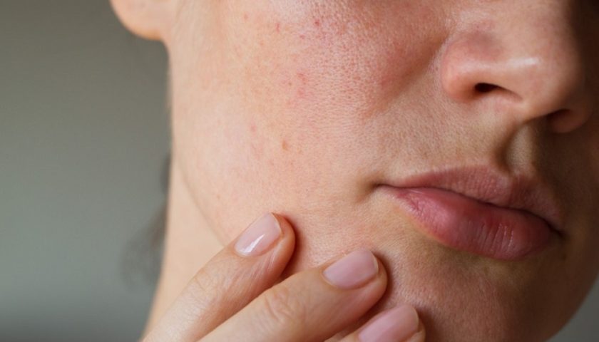 Toasted Skin Syndrome