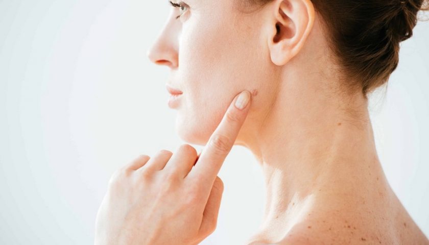 Dealing with Skin Moles