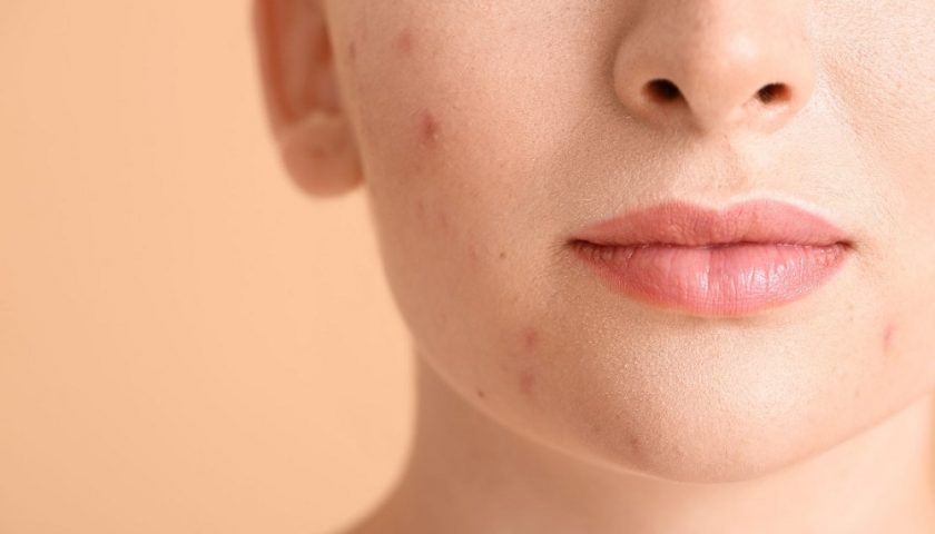Hormonal Acne Symptoms