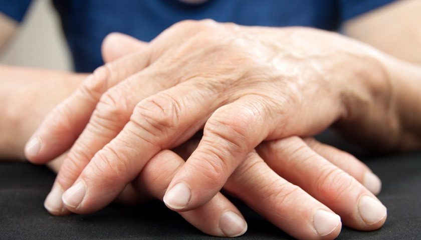 Rheumatoid Arthritis Symptoms