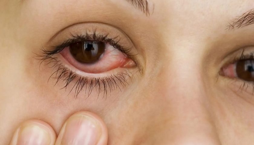 What is Pink Eye