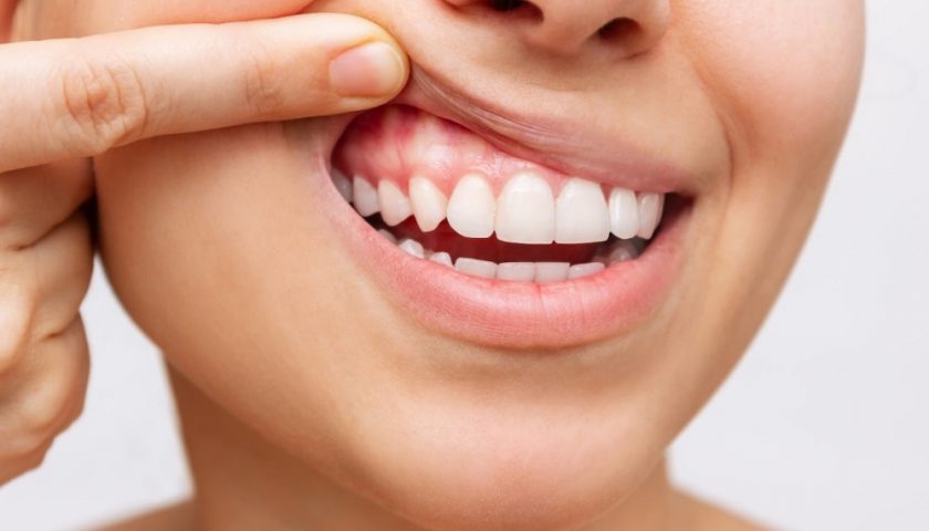 When Do You Need a Gum Biopsy