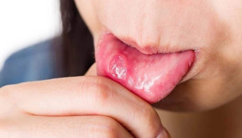 Staph Infection in Mouth