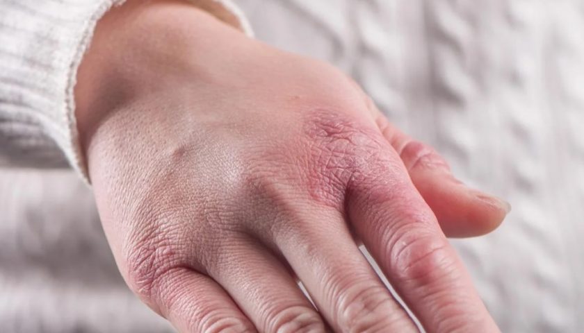 Chilblains